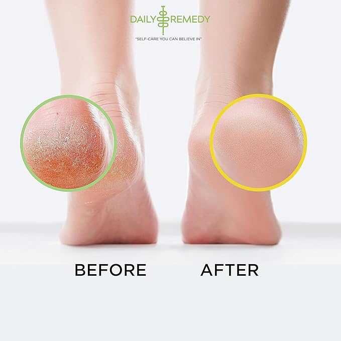 DAILY REMEDY EXTRA STRENGTH Tea Tree Oil & Citrus Detox Foot Soak Set - Made in USA - Soothes Sore Tired Feet, Athletes Foot, Stubborn Foot Odor, Softens Calluses & Refreshes & Detoxifies - Pack of 2